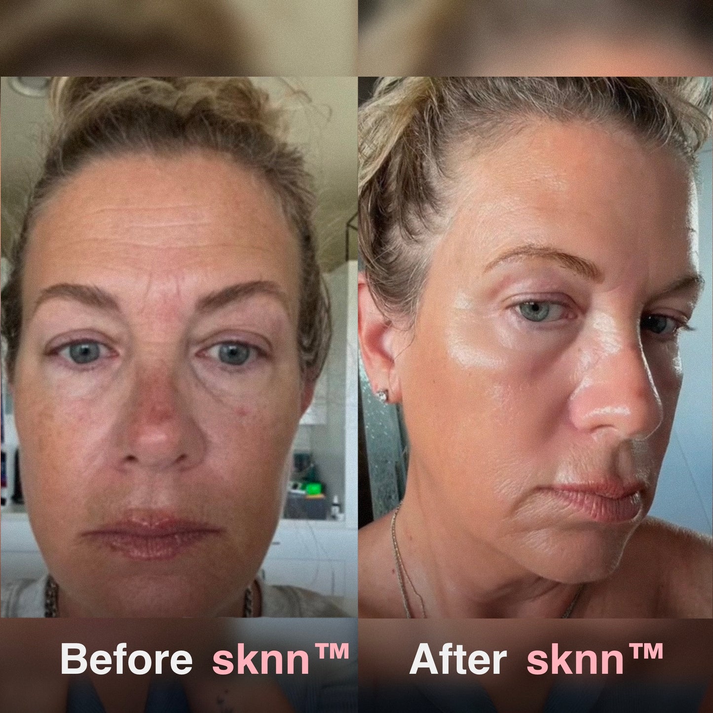 sknn™ Microinfusion System