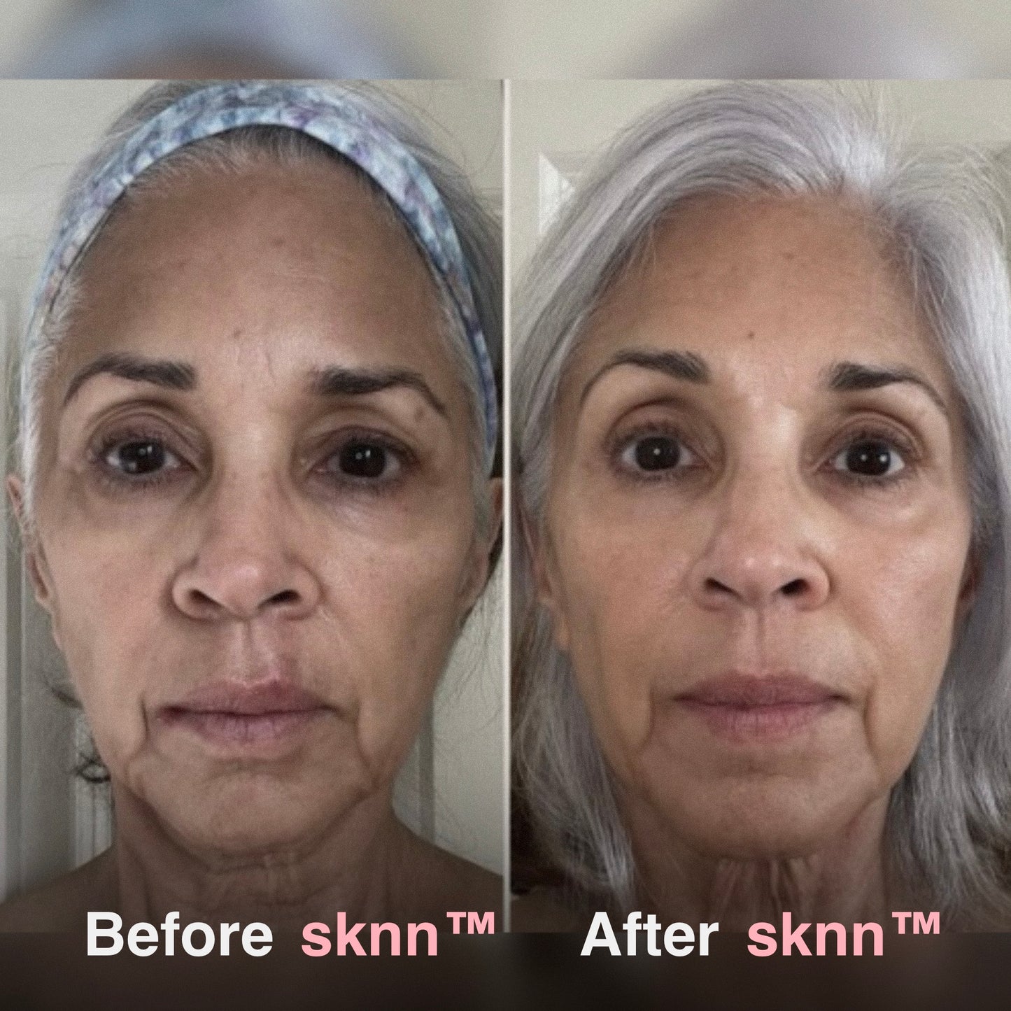 sknn™ Microinfusion System