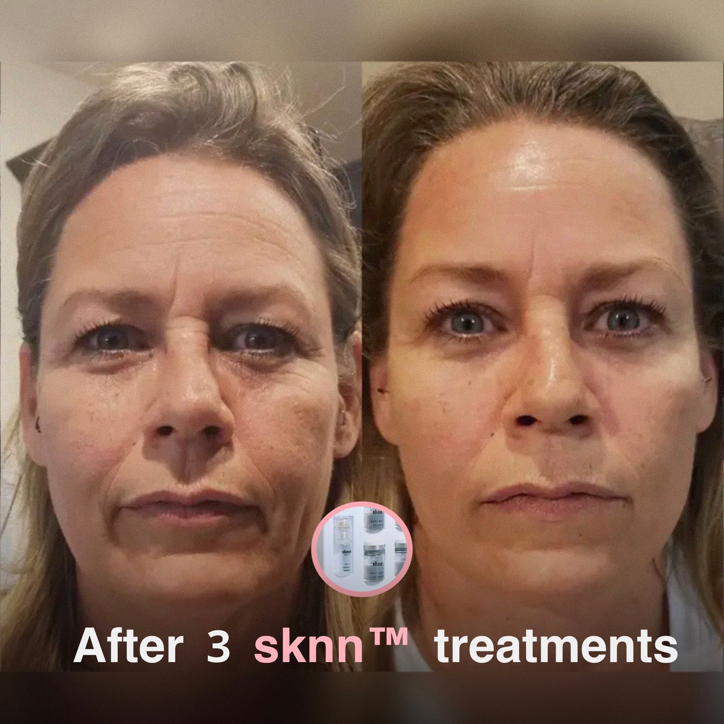 sknn™ Microinfusion System