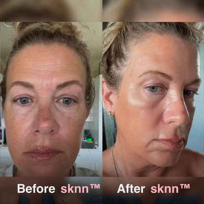 sknn™ Microinfusion System