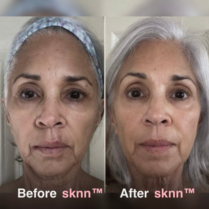 sknn™ Microinfusion System